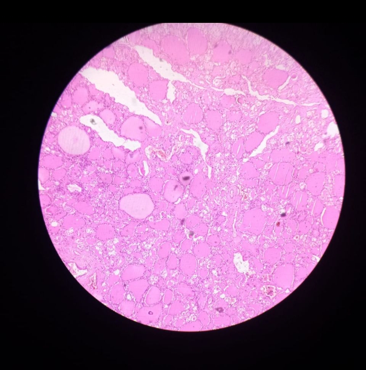 甲状腺真实图片